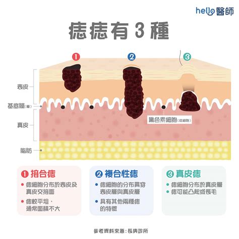 脖子痣長毛|痣變大、痣多或長毛會變皮膚癌？認識痣的形成與原因